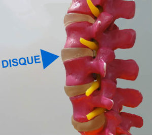 photo d'une colonne vertebrale montrant un disque