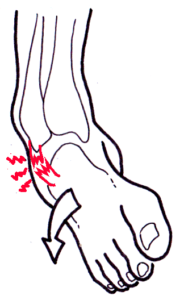 dessin mécanisme entorse cheville ligament douleur pour cabinet ostéopathie cébazat proche de ladoux et gerzat